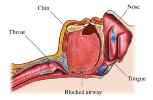 OSA Treatment Options in Columbus